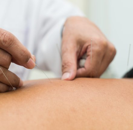 Acupuncture & Dry Needling